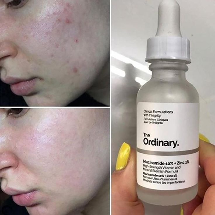 Ordinary Niacinamide 10% + Zinc 1% Serum